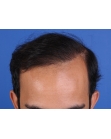 After Hair Transplant&nbsp;Front